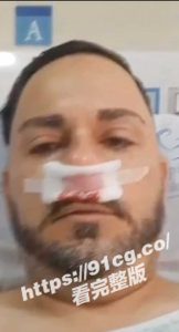 偷情出伤！外国大只佬鼻青脸肿看医羞不敢说出真实原因